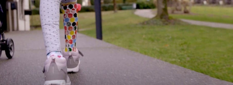 Girl wearing 3D printed leg orthotics walking on sidewalk