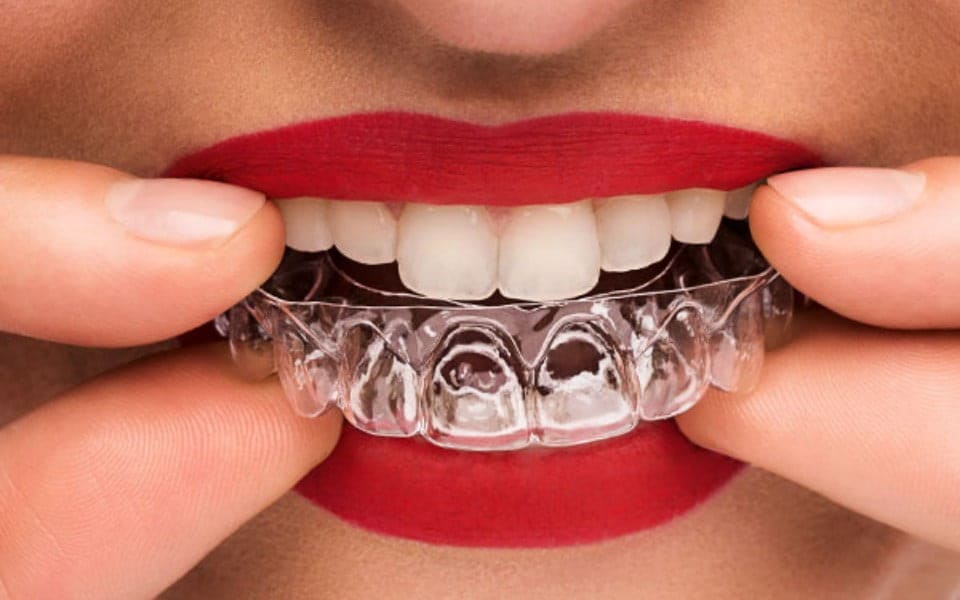 clear aligner in 3D printing dental by nivellmedical